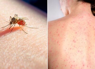 Período epidémico: la ciudad de Moreno tiene a 16 vecinos con dengue