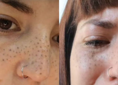 Se hizo una micropigmentación para resaltar sus pecas y asegura que le dejaron manchas negras en la cara